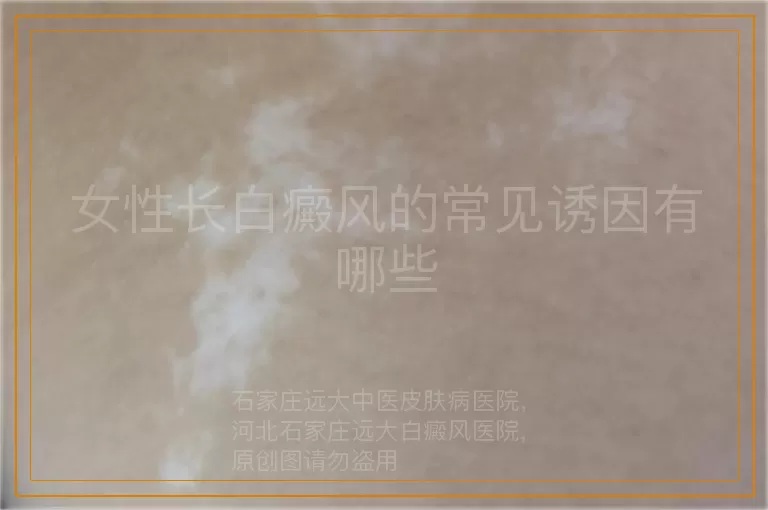 女性长白癜风的常见诱因有哪些