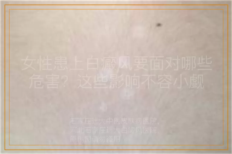 女性患上白癜风要面对哪些危害？这些影响不容小觑