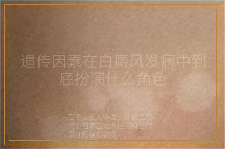 遗传因素在白癜风发病中到底扮演什么角色