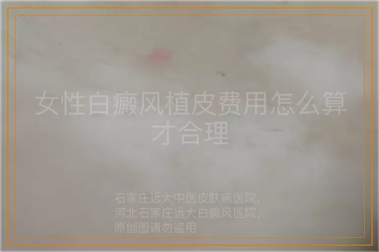 女性白癜风植皮费用怎么算才合理