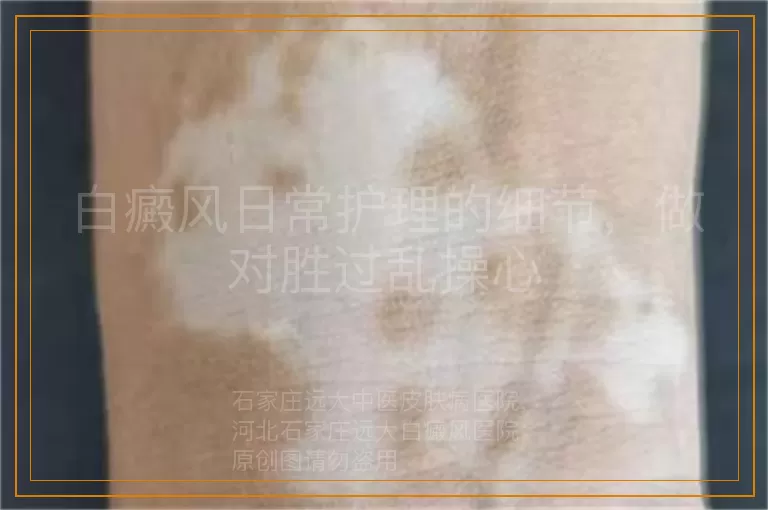 白癜风日常护理的细节，做对胜过乱操心
