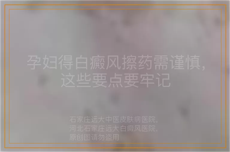 孕妇得白癜风擦药需谨慎，这些要点要牢记