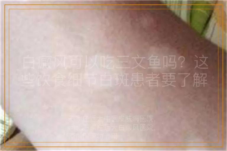 白癜风可以吃三文鱼吗？这些饮食细节白斑患者要了解
