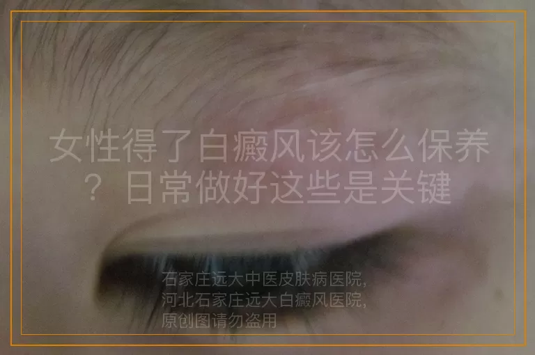女性得了白癜风该怎么保养？日常做好这些是关键