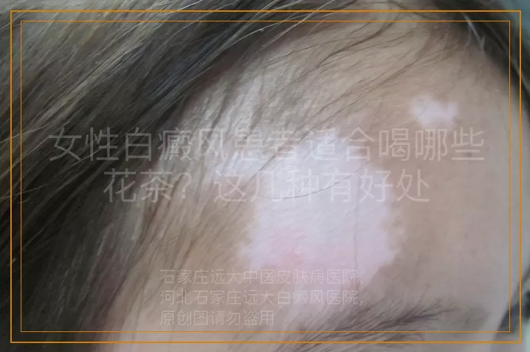 女性白癜风患者适合喝哪些花茶？这几种有好处