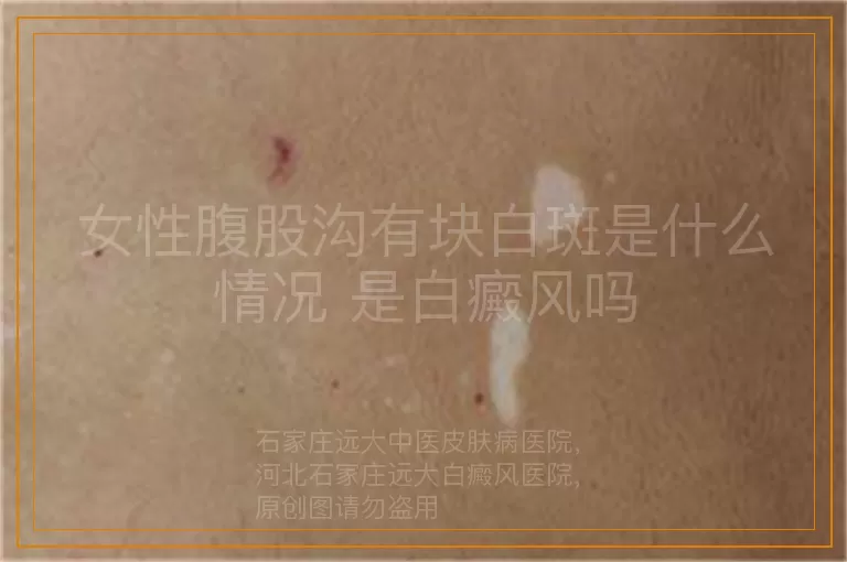 女性腹股沟有块白斑是什么情况 是白癜风吗