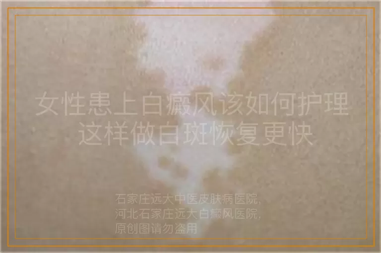 女性患上白癜风该如何护理 这样做白斑恢复更快