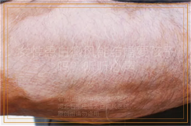 女性患白癜风能结婚要孩子吗？听听心声