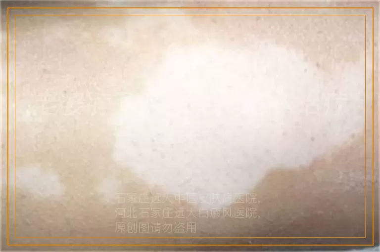 老婆脖子有白癜风怎么治疗效果好