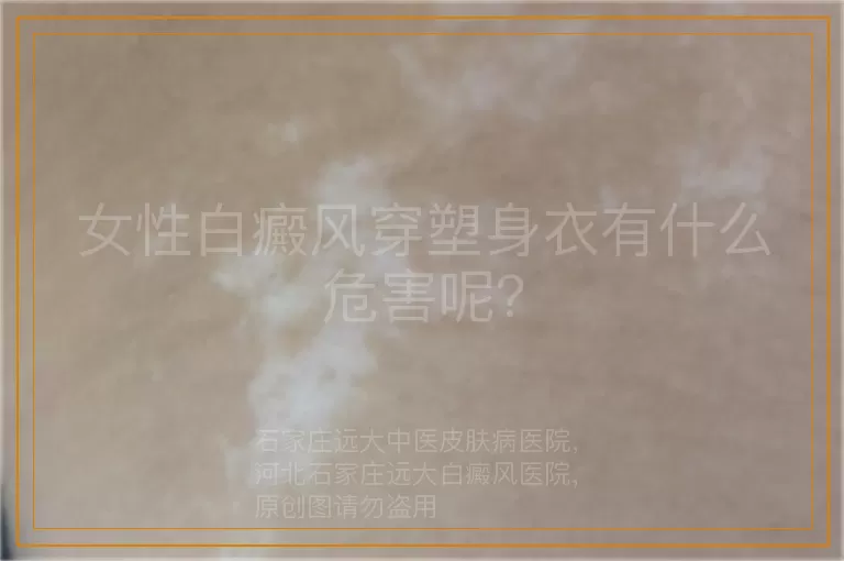 女性白癜风穿塑身衣有什么危害呢？