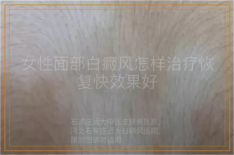 女性面部白癜风怎样治疗恢复快效果好
