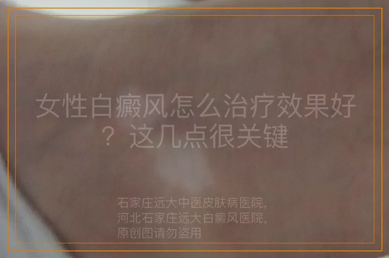 女性白癜风怎么治疗效果好？这几点很关键