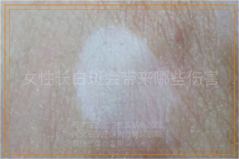 女性长白斑会带来哪些伤害
