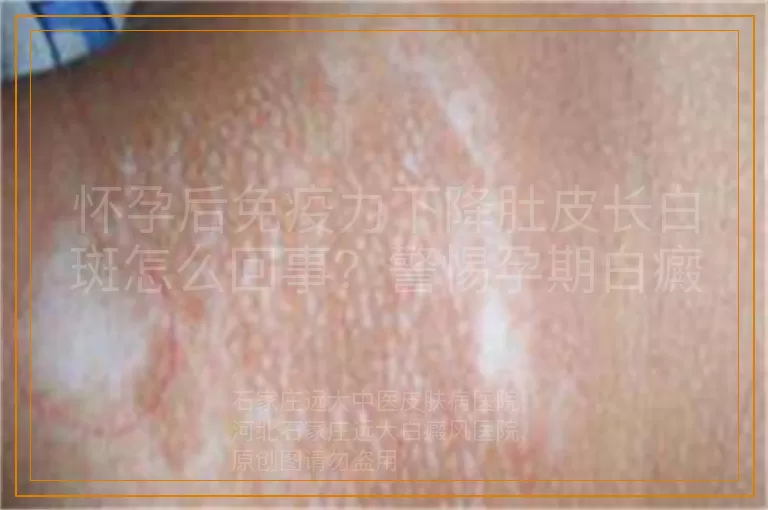 怀孕后免疫力下降肚皮长白斑怎么回事？警惕孕期白癜风