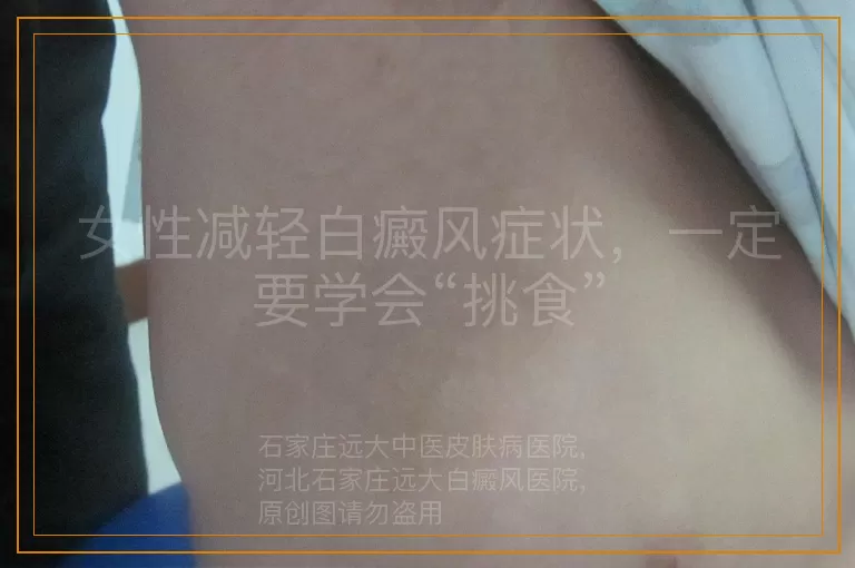 女性减轻白癜风症状，一定要学会“挑食”