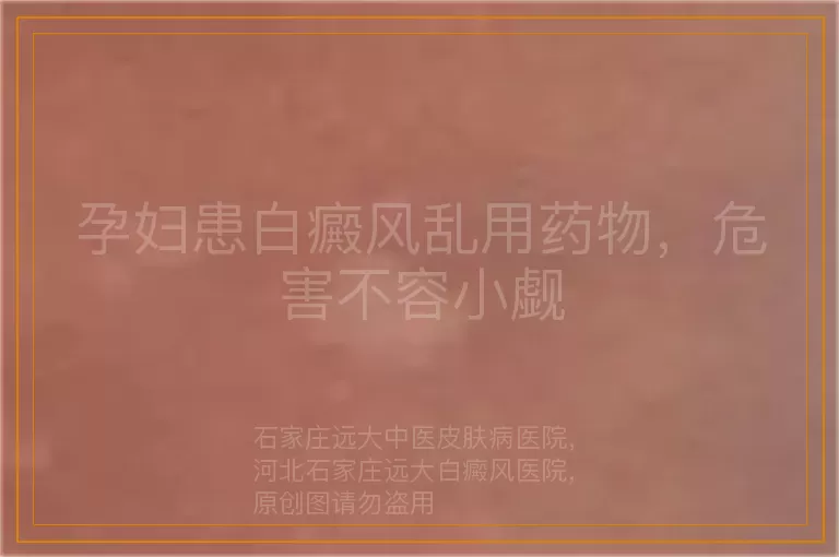孕妇患白癜风乱用药物，危害不容小觑
