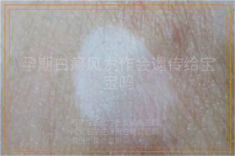 孕期白癜风发作会遗传给宝宝吗