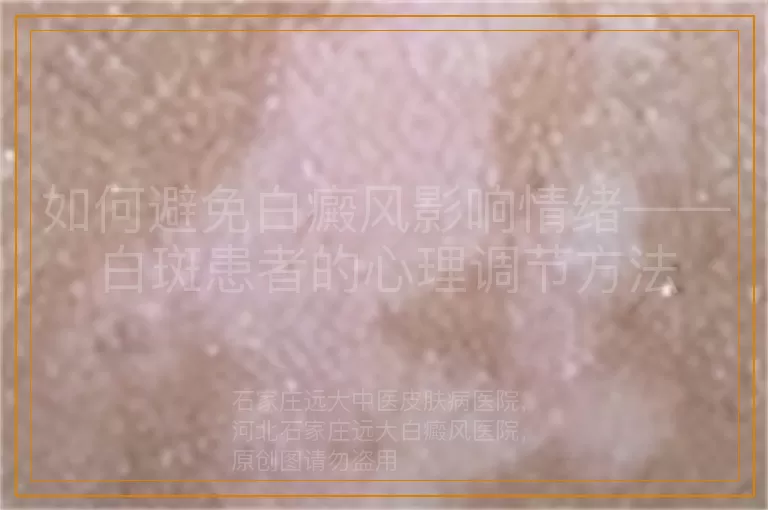 如何避免白癜风影响情绪——白斑患者的心理调节方法