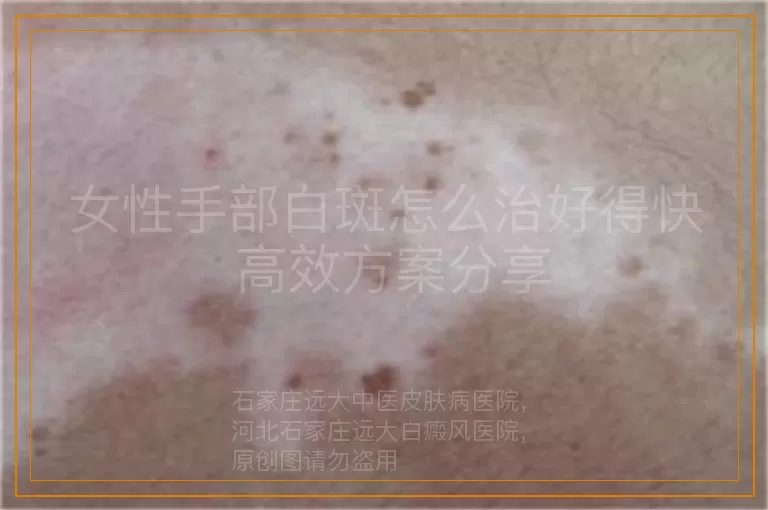 女性手部白斑怎么治好得快 高效方案分享