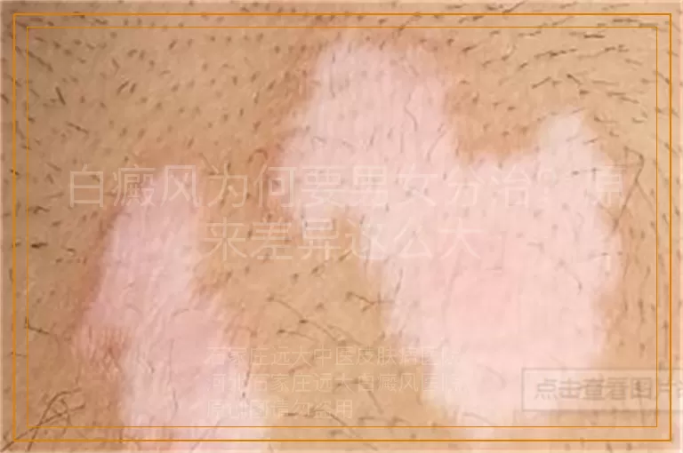 白癜风为何要男女分治？原来差异这么大