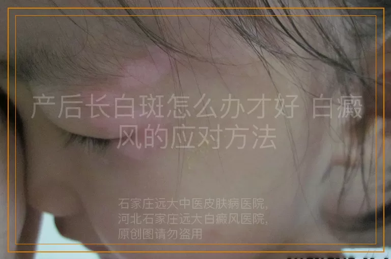 产后长白斑怎么办才好 白癜风的应对方法