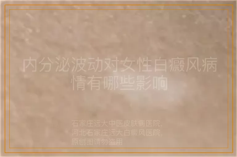 内分泌波动对女性白癜风病情有哪些影响