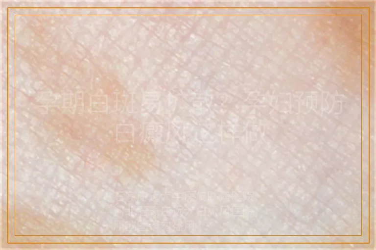 孕期白斑易扩散？孕妇预防白癜风这样做