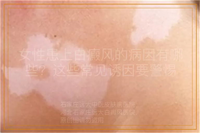 女性患上白癜风的病因有哪些？这些常见诱因要警惕