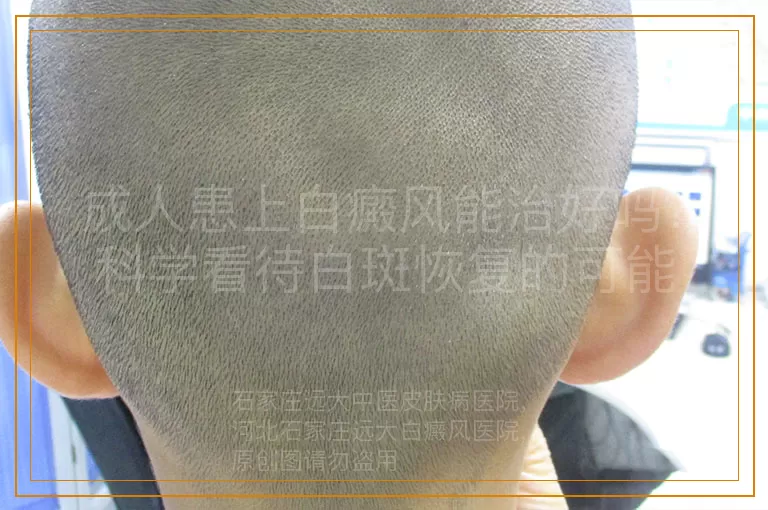 成人患上白癜风能治好吗？科学看待白斑恢复的可能