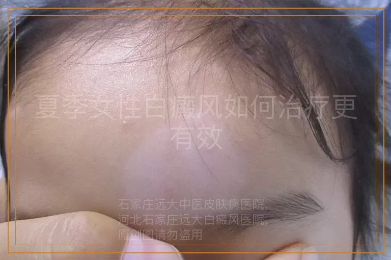 夏季女性白癜风如何治疗更有效