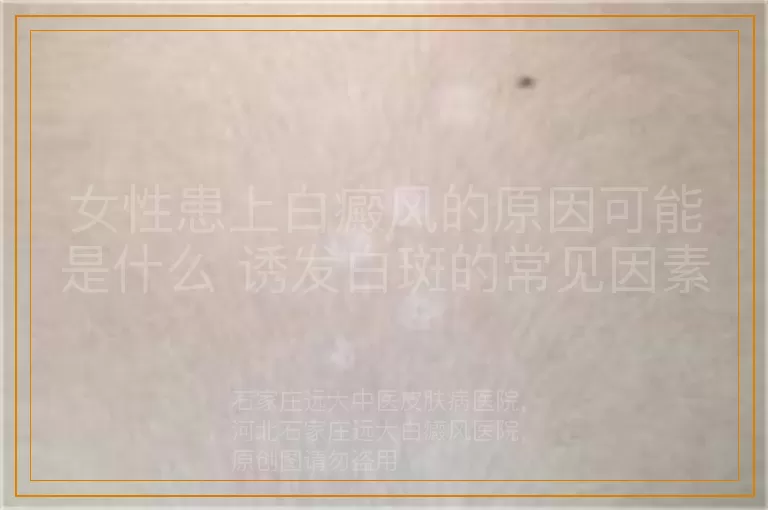 女性患上白癜风的原因可能是什么 诱发白斑的常见因素解读