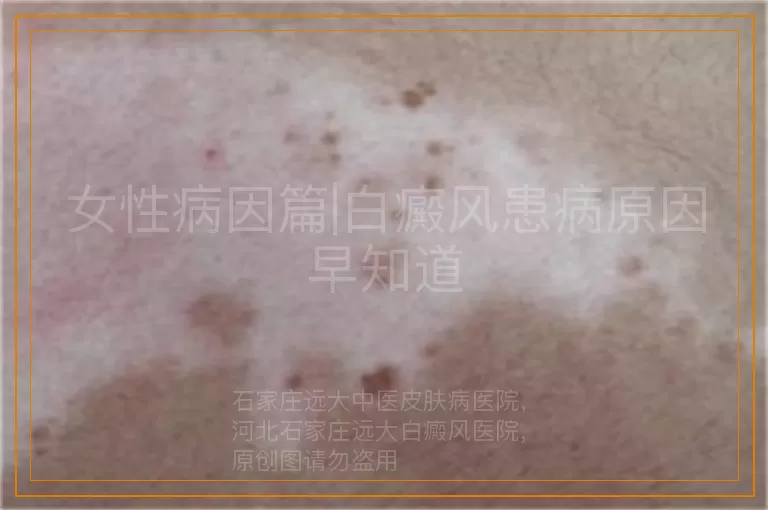 女性病因篇|白癜风患病原因早知道