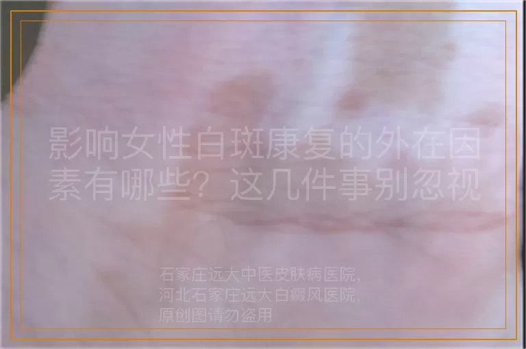影响女性白斑康复的外在因素有哪些？这几件事别忽视