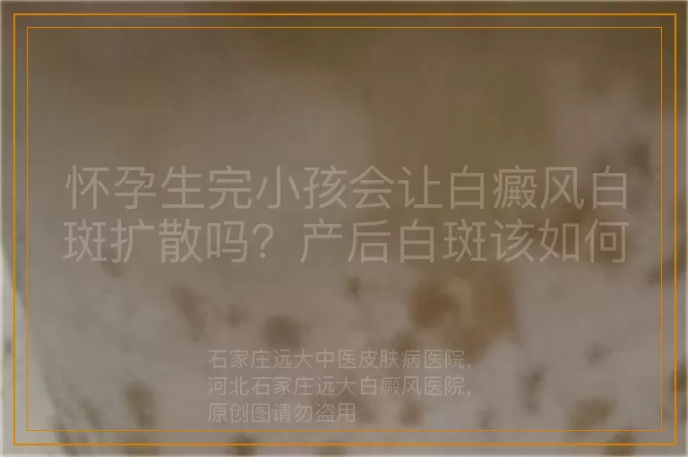 怀孕生完小孩会让白癜风白斑扩散吗？产后白斑该如何应对