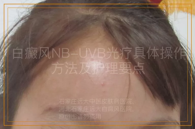 白癜风NB-UVB光疗具体操作方法及护理要点