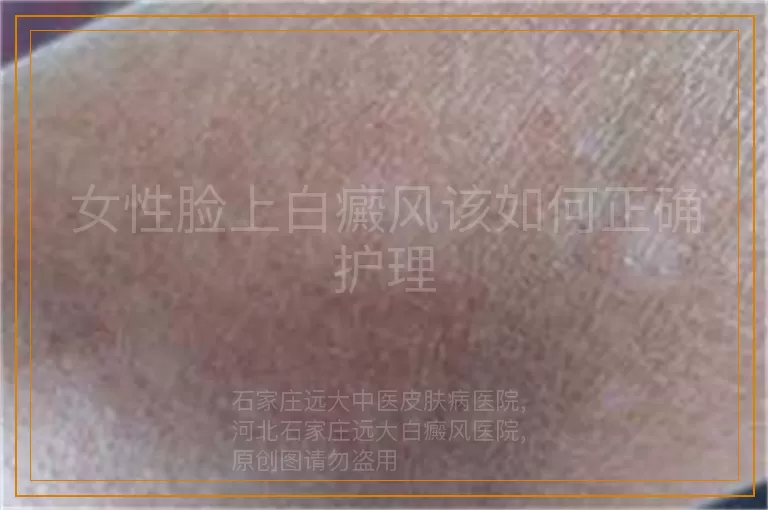 女性脸上白癜风该如何正确护理