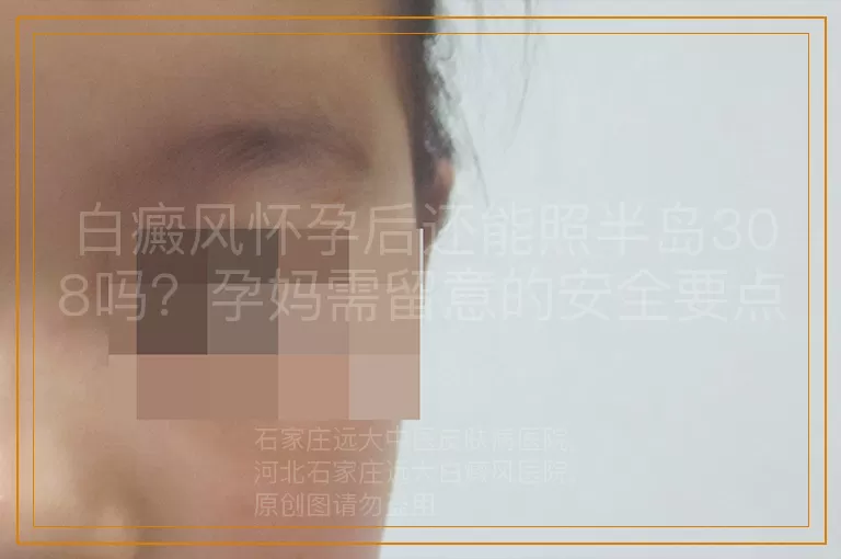 白癜风怀孕后还能照半岛308吗？孕妈需留意的安全要点