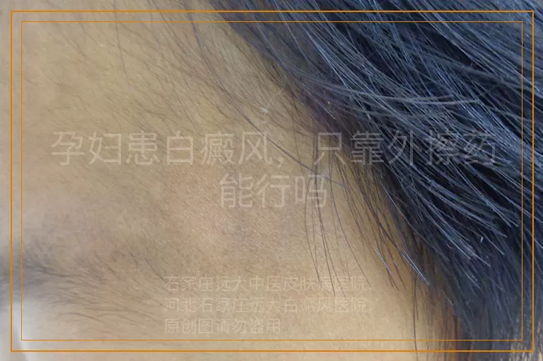 孕妇患白癜风，只靠外擦药能行吗