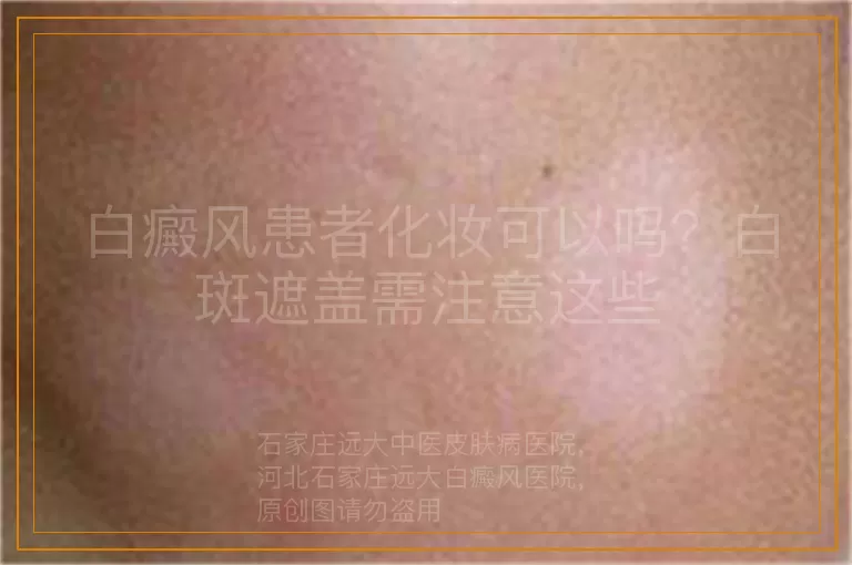 白癜风患者化妆可以吗？白斑遮盖需注意这些