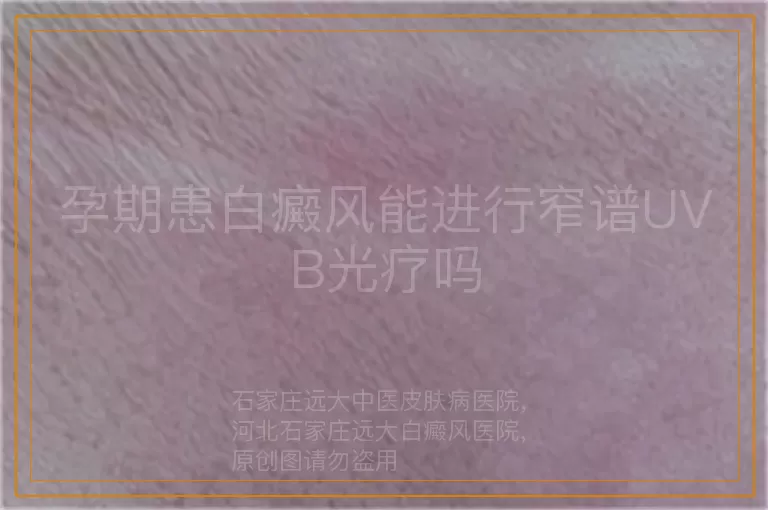 孕期患白癜风能进行窄谱UVB光疗吗