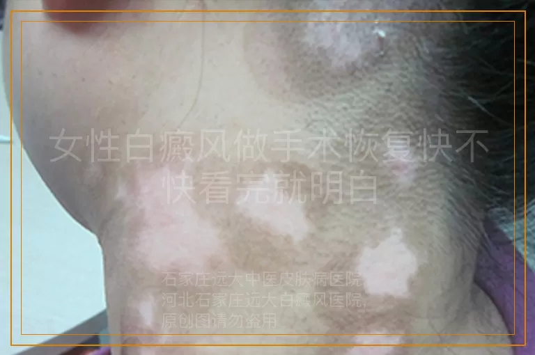 女性白癜风做手术恢复快不快看完就明白
