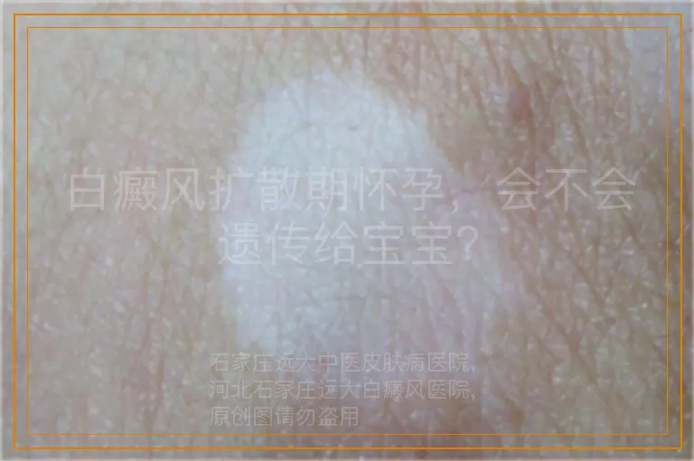 白癜风扩散期怀孕，会不会遗传给宝宝？