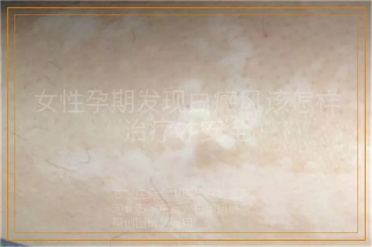 女性孕期发现白癜风该怎样治疗才安全