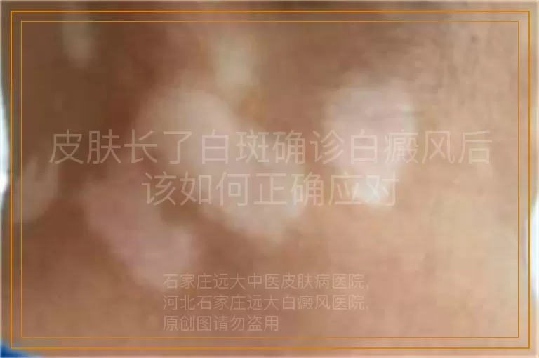 皮肤长了白斑确诊白癜风后该如何正确应对