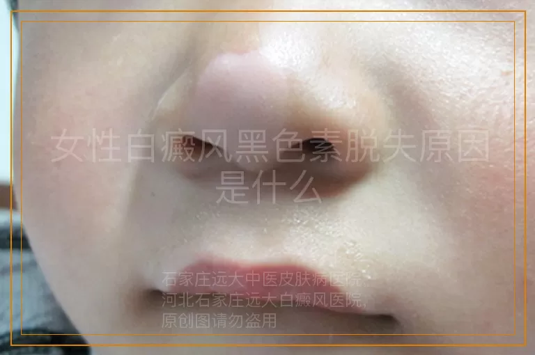 女性白癜风黑色素脱失原因是什么