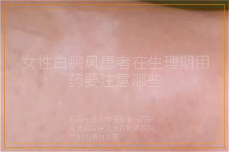 女性白癜风患者在生理期用药要注意哪些