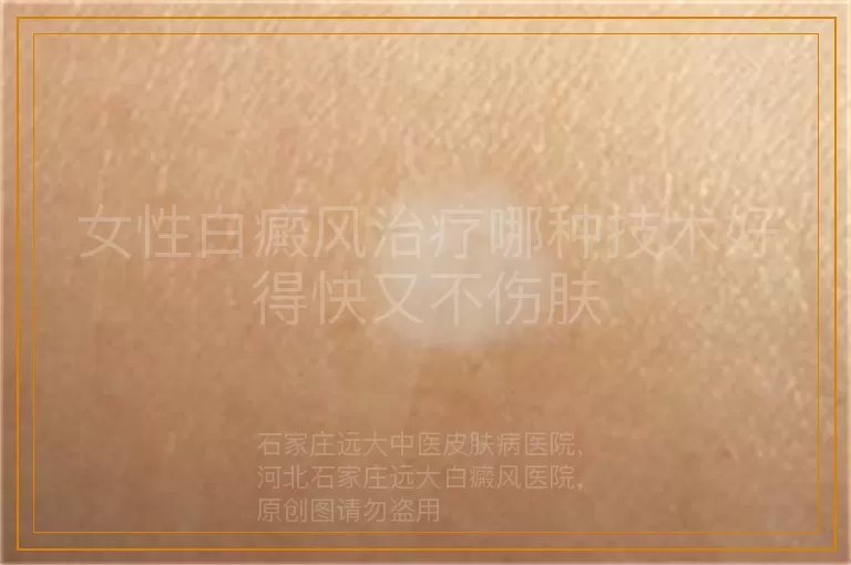女性白癜风治疗哪种技术好得快又不伤肤