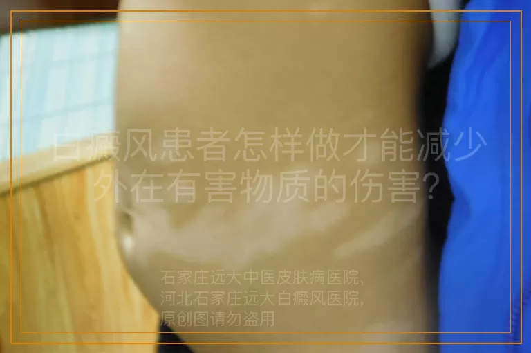 白癜风患者怎样做才能减少外在有害物质的伤害？