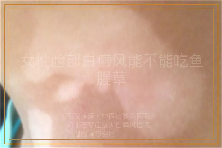女性脸部白癜风能不能吃鱼腥草