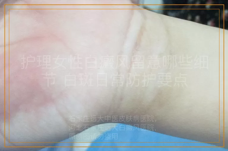 护理女性白癜风留意哪些细节 白斑日常防护要点